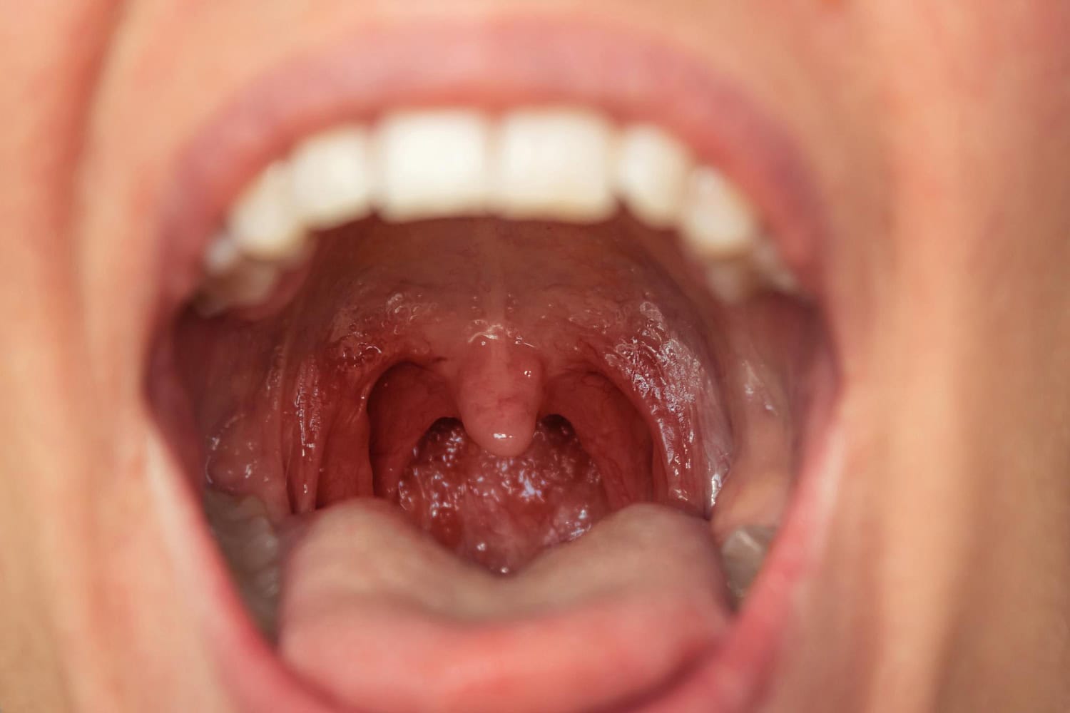 Throat & Tonsil Treatment in Raipur - Maa Ahilya Abhinandan